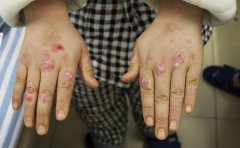 手部银屑病初期症状有哪些症状
