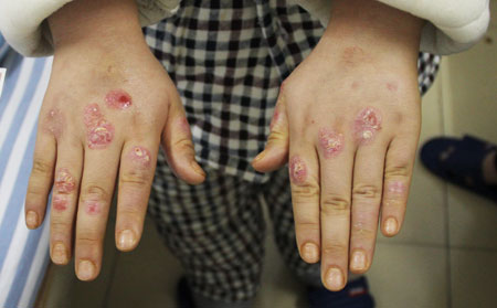 分享手部银屑病初期症状有哪些症状图片
