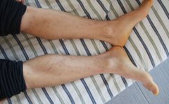 脚上患有银屑病怎么治疗好呢