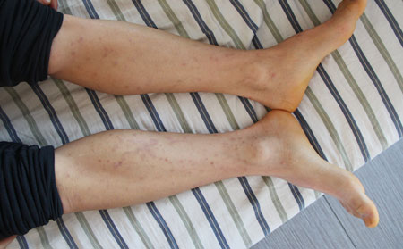 分享脚上患有银屑病怎么治疗好呢图片